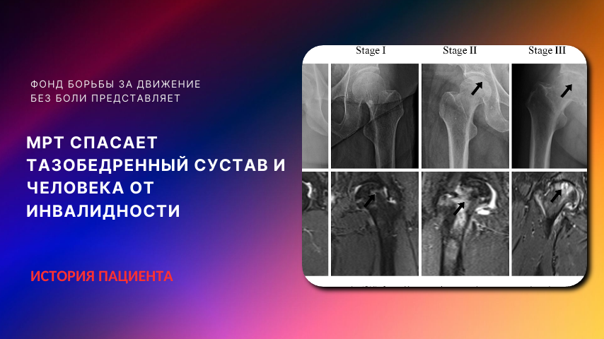 Боль в паху. Хуже, чем артроз. Сустав умирает! Обязательно прочитайте.