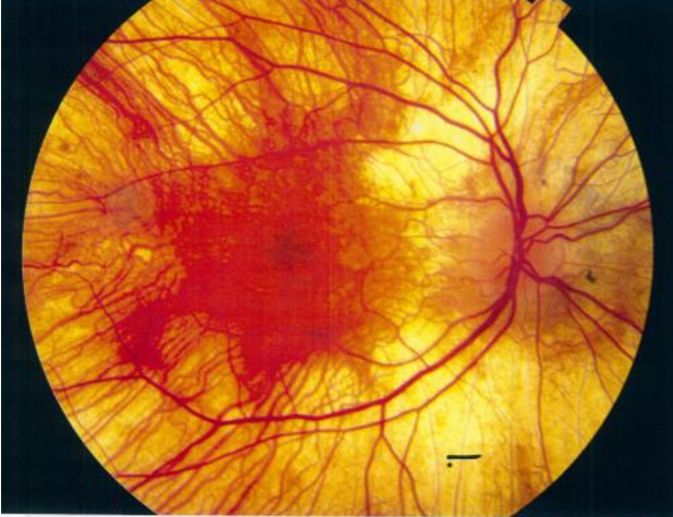 Источник: Фонд исследований и лечения заболеваний сетчатки глаза «РетинаФонд»