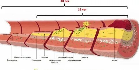 Этапы развития атеросклероза