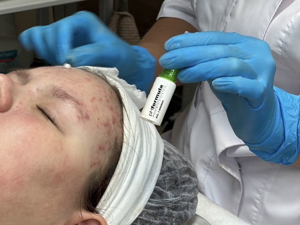 Пилинг Ph formula