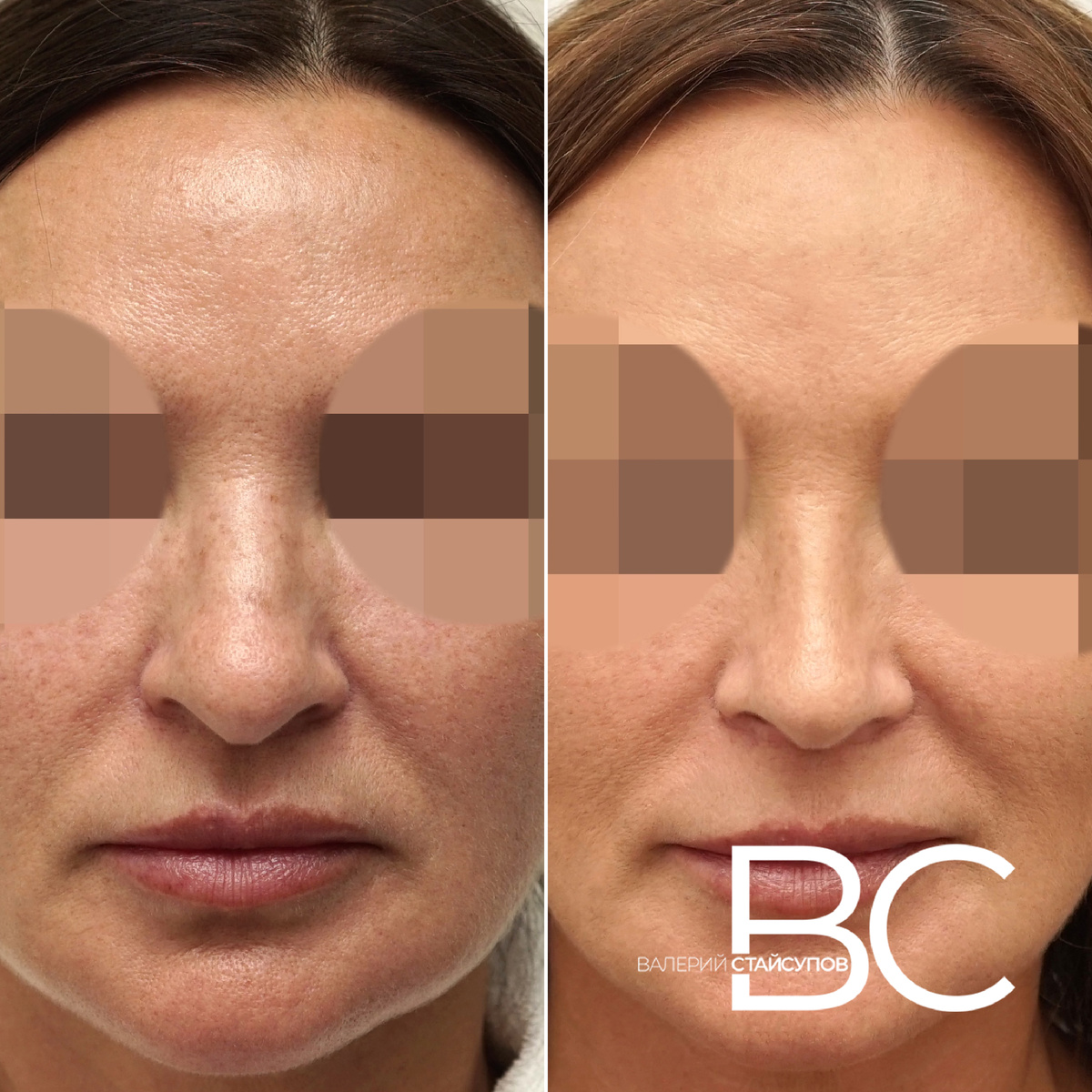 Закрытая ринопластика, до и 6 месяцев после операции, пластический хирург Стайсупов В.Ю.