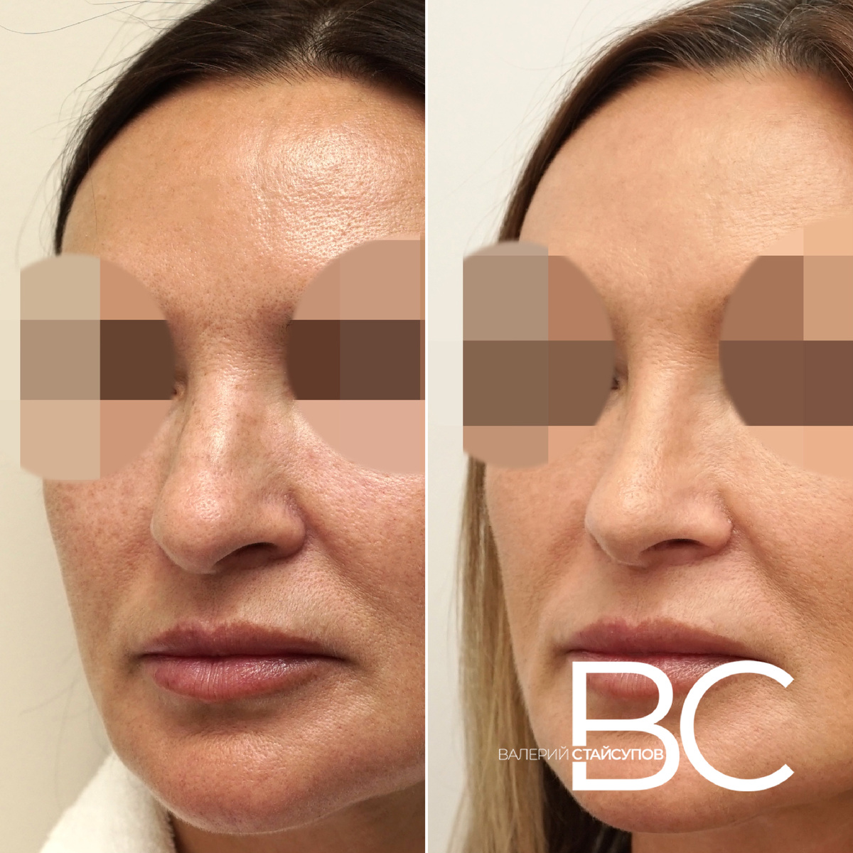 Закрытая ринопластика, до и 6 месяцев после операции, пластический хирург Стайсупов В.Ю.