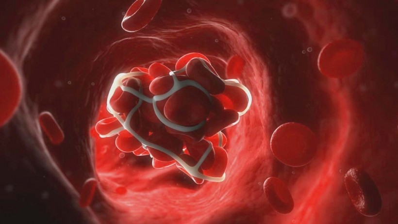 «Густая кровь»: причины, симптомы, опасности и профилактика