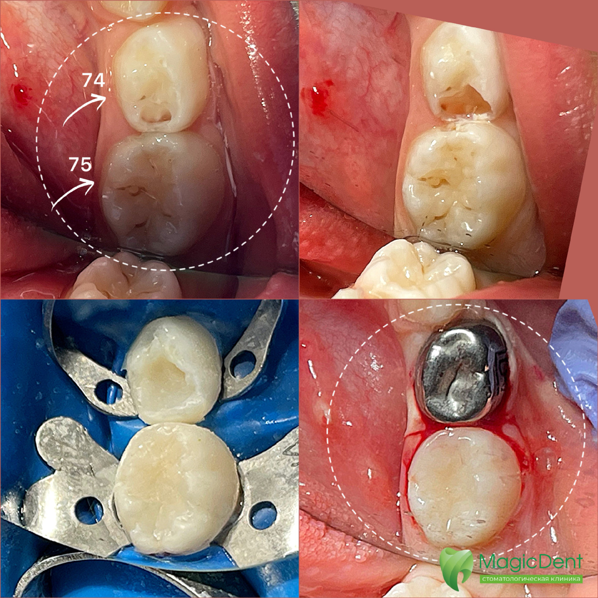Лечение кариеса 74 зуба и пульпита 75 зуба. Зубы молочные.