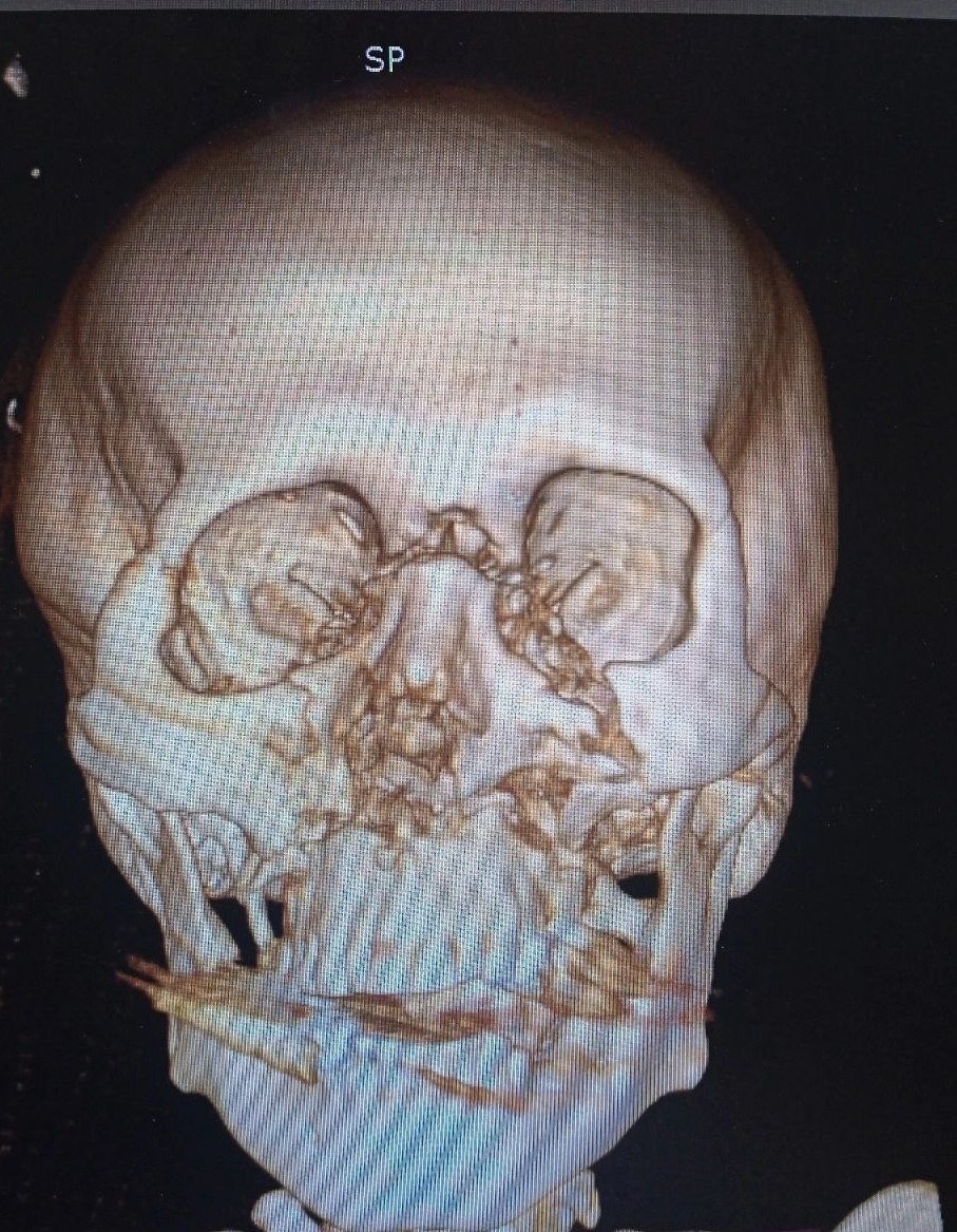 Снимок черепа пострадавшего. Фото Минздрава Подмосковья.