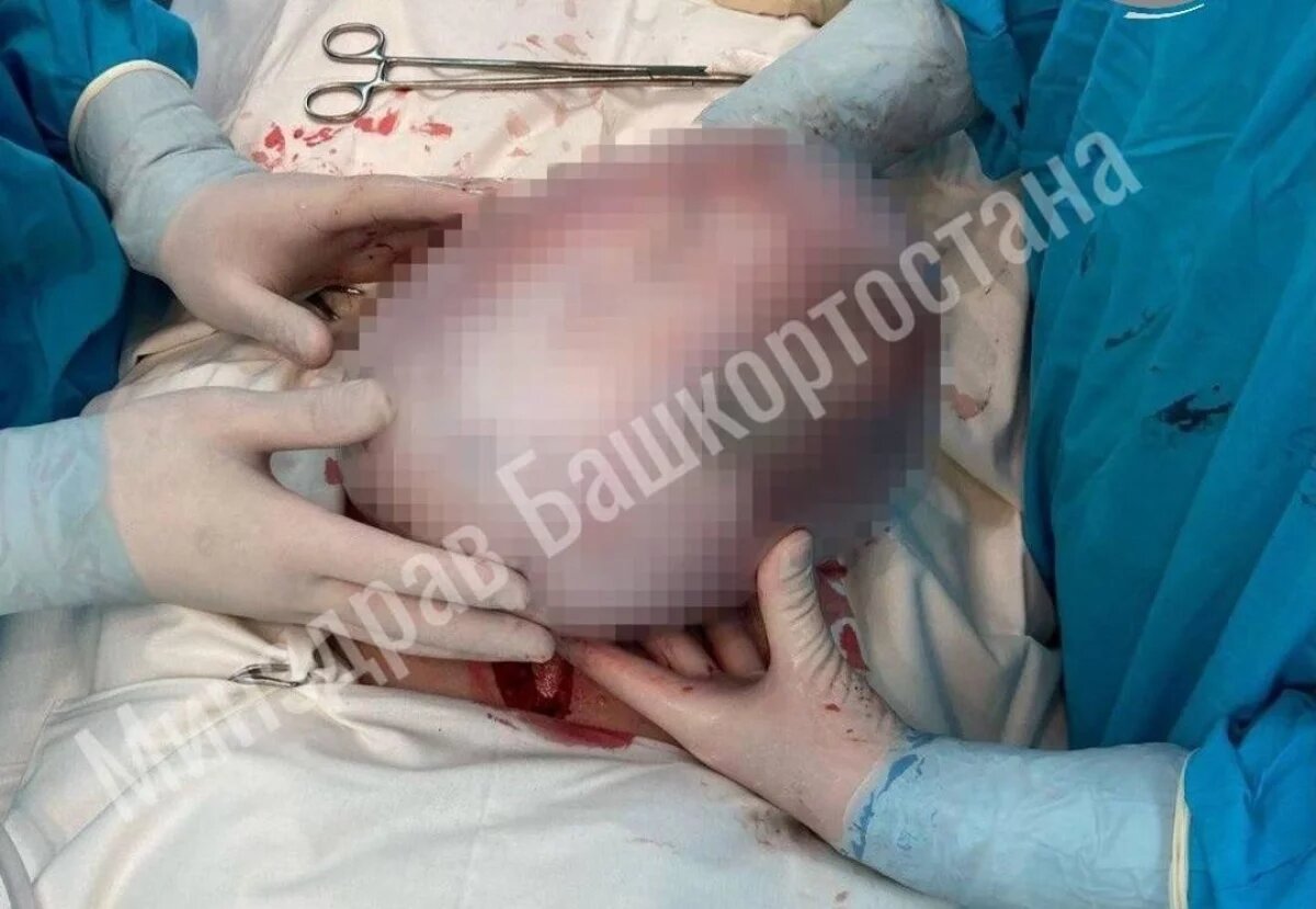   В Уфе врачи удалили у 67-летней пациентки гигантскую опухоль яичника