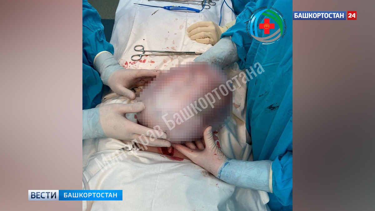    В Уфе успешно удалили огромную опухоль яичника у 67-летней пациентки