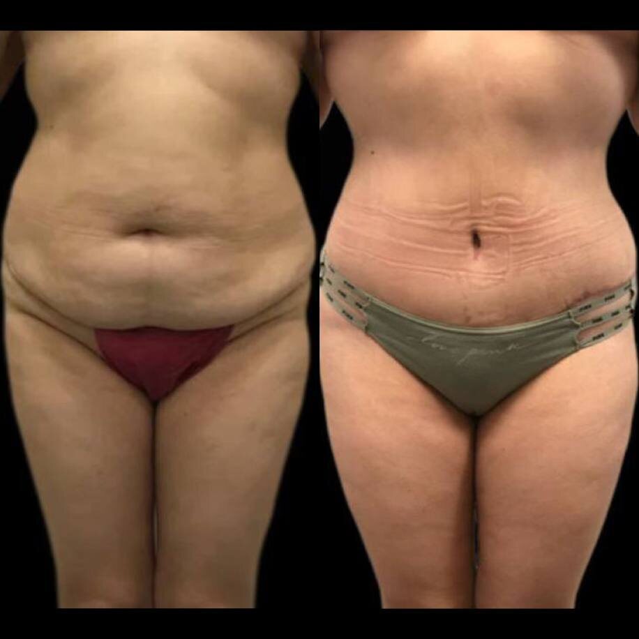 Результат после абдоминопластики и липосакции животы и боков