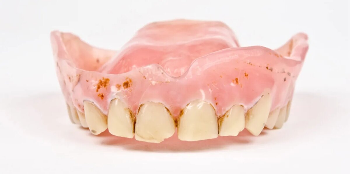 Неухоженный полный съемный протез из пластмассы