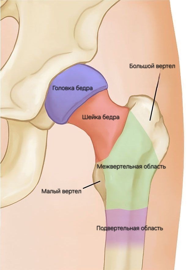 Цветами обозначены зоны переломов проксимального отдела бедренной кости. https://pin.it/2kSaM8CE5