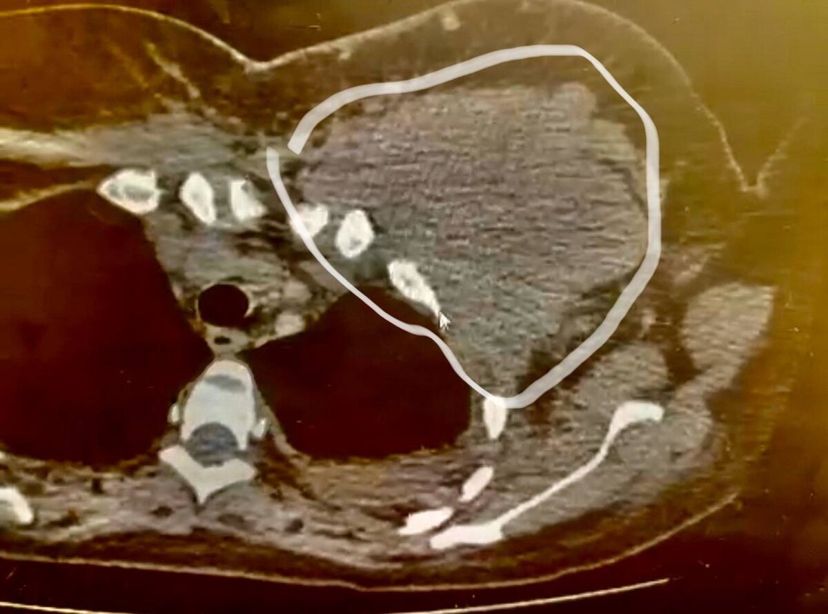 Опухоль молочной железы, проростающая в грудную клетку со здавлением легкого. (фото из личных архивов)