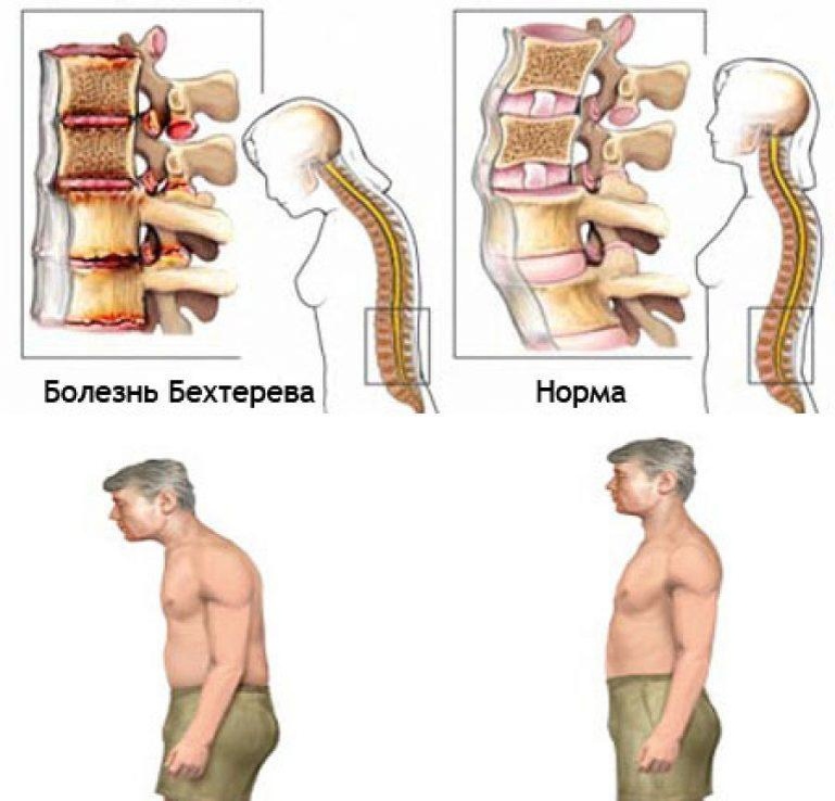 Тело приобретает "позу просителя" с дальнейшей инвалидизацией человека