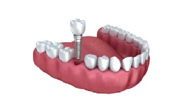 Челюсть с имплантом (преследует меня вот уже две недели)