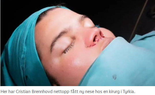 Сейчас у Кристиана "родился" новый нос.