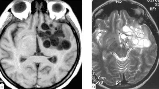 Множественные эхинококковые кисты в мозгу человека