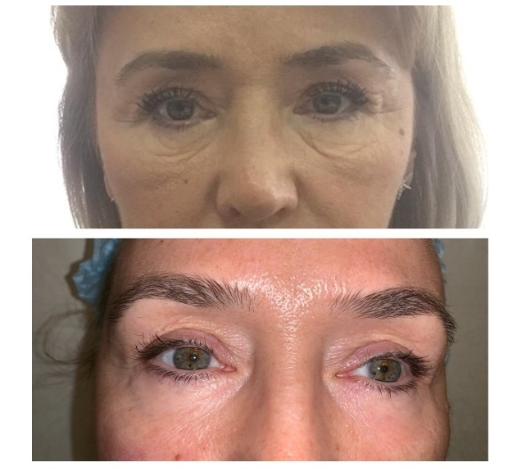 Фото до и после шлифовки лазером Fraxel