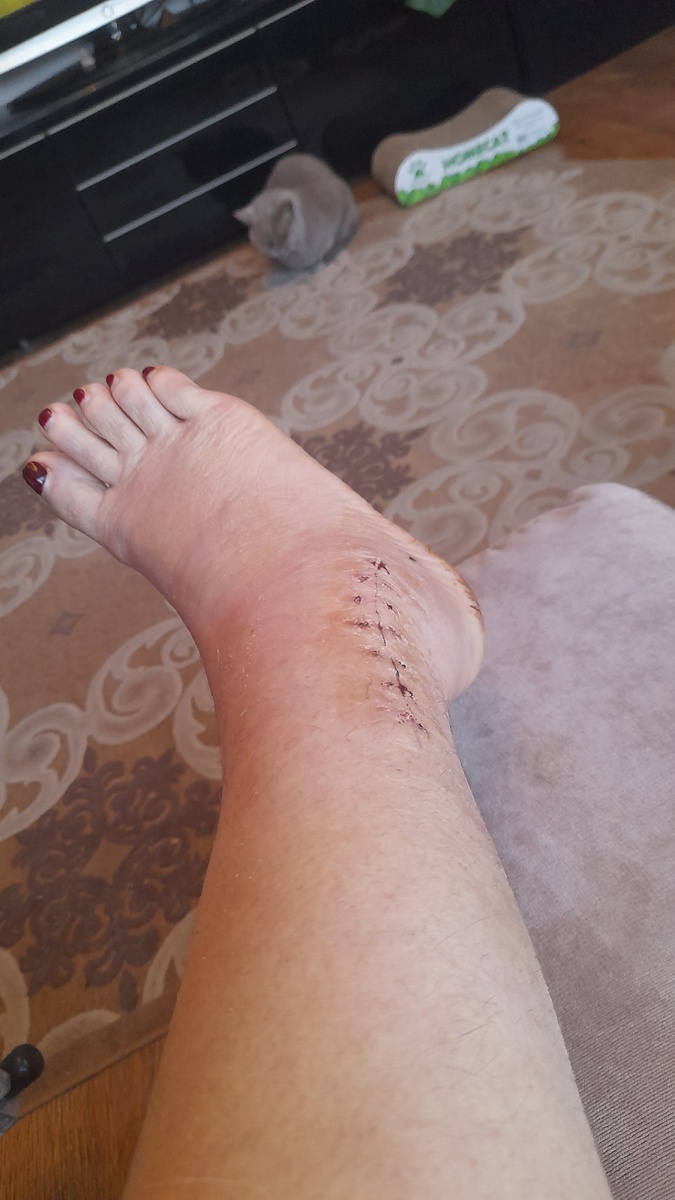 Так сейчас выглядит моя нога, с другой стороны тоже зашито...