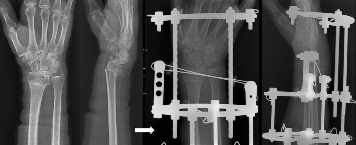 Рентгенограммы пациента 58 лет. До и во время лечения