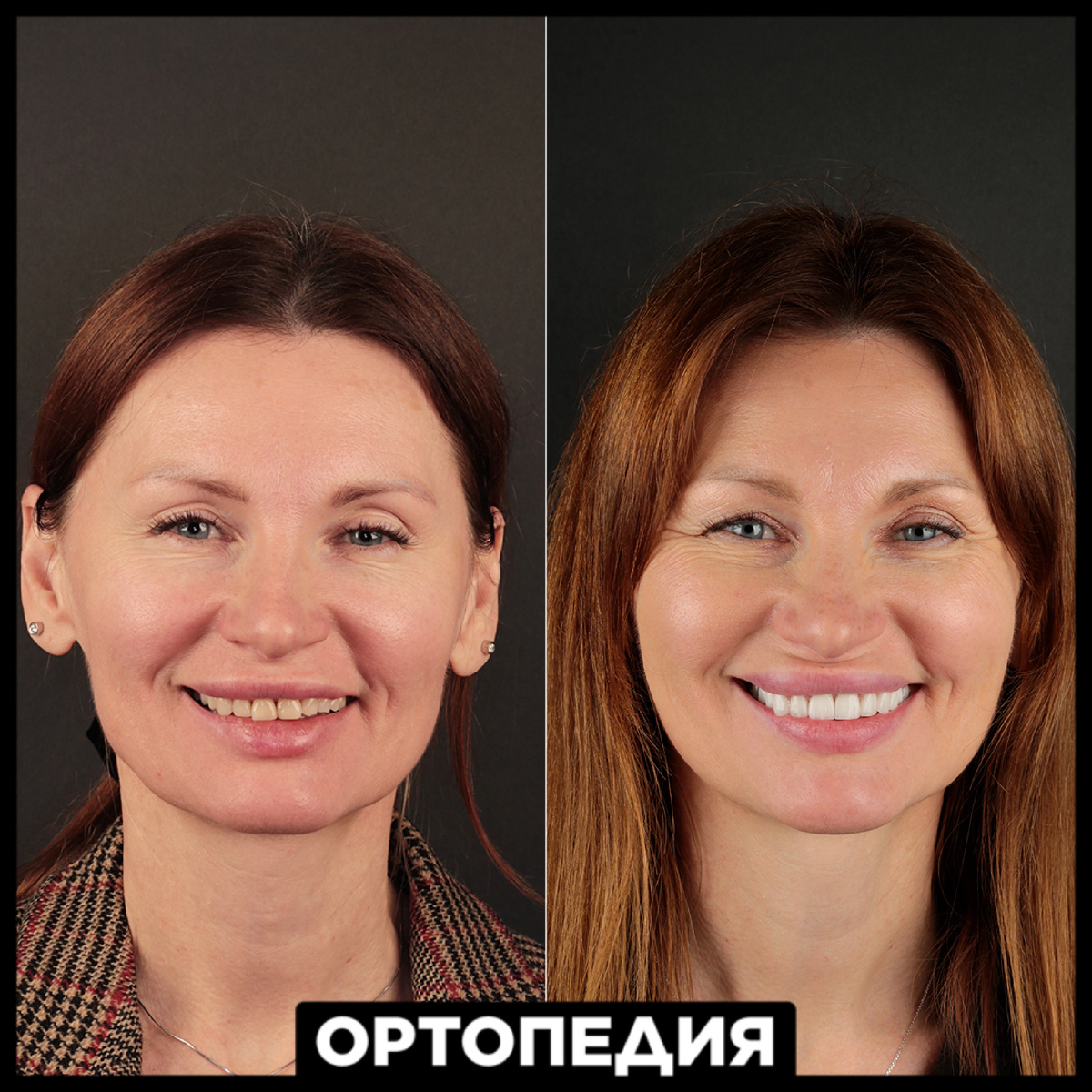 Реконструкция улбыки у пациентки 45-ти лет