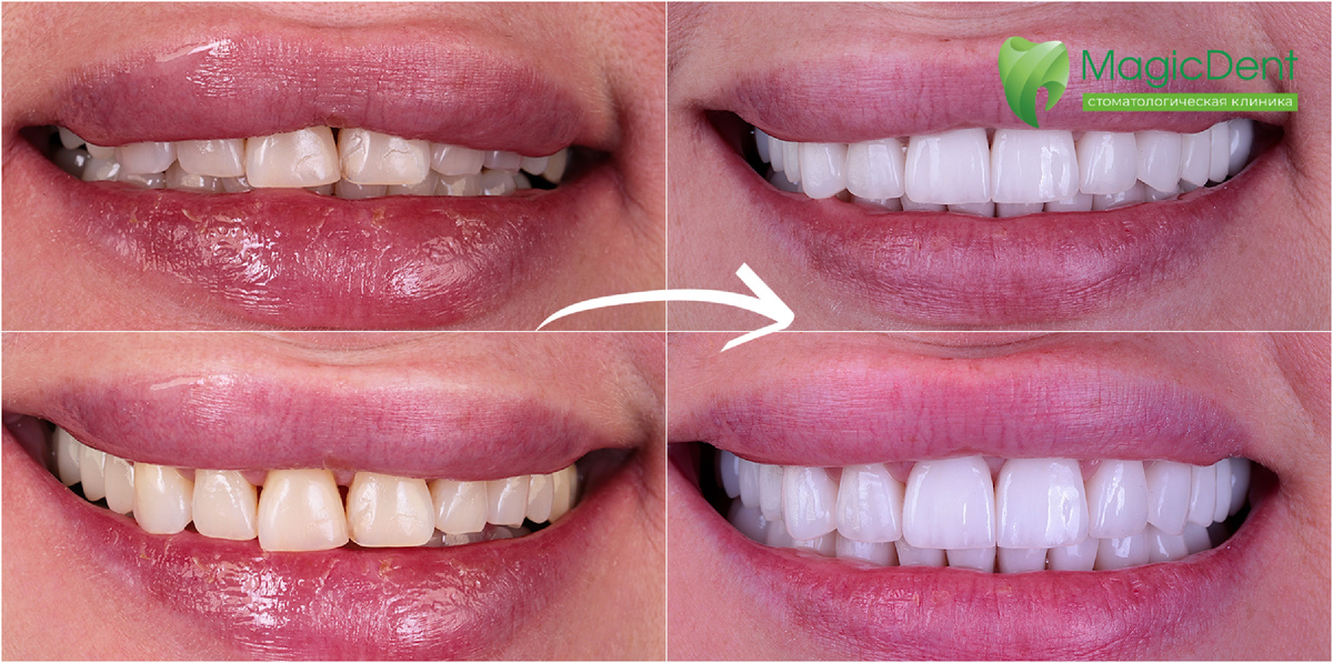 28 керамических виниров E.Max и коронок из диоксид циркония с нанесением керамики