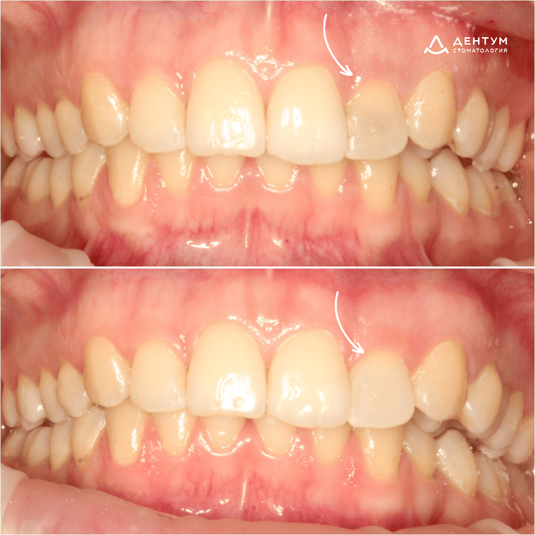 Внутриканальное отбеливание. Зуб 22. Врач: Зубко Юрий Павлович