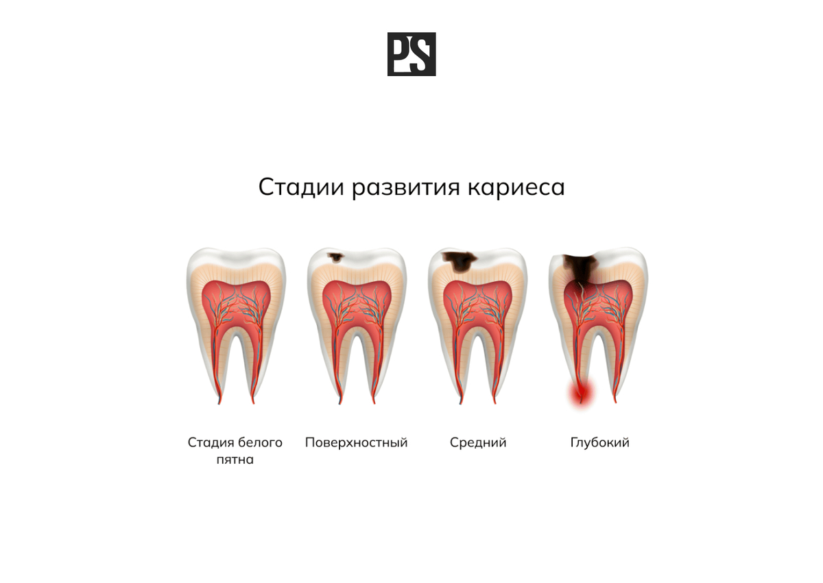 Стадии развития кариеса