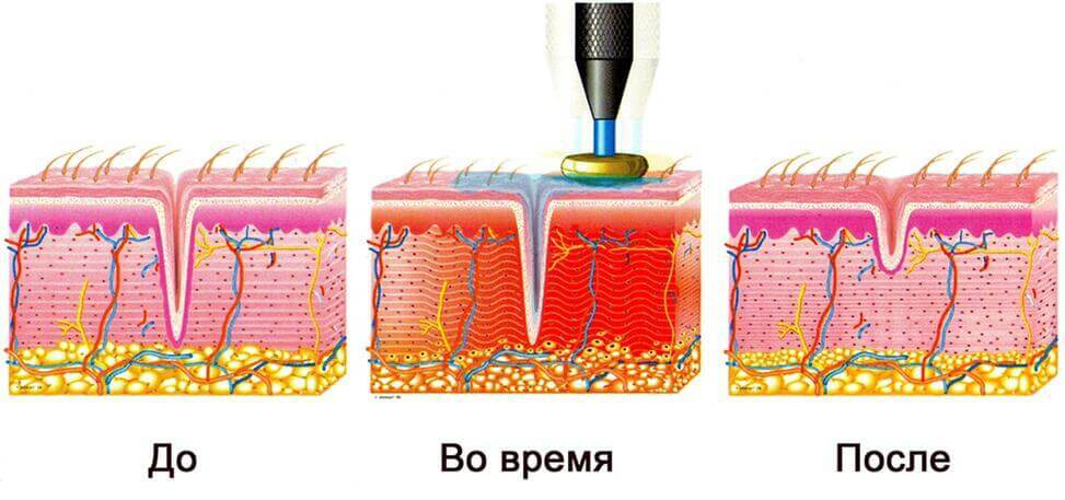Как выбрать аппарат для RF-лифтинга: полное руководство для профессионалов и домашних пользователей
