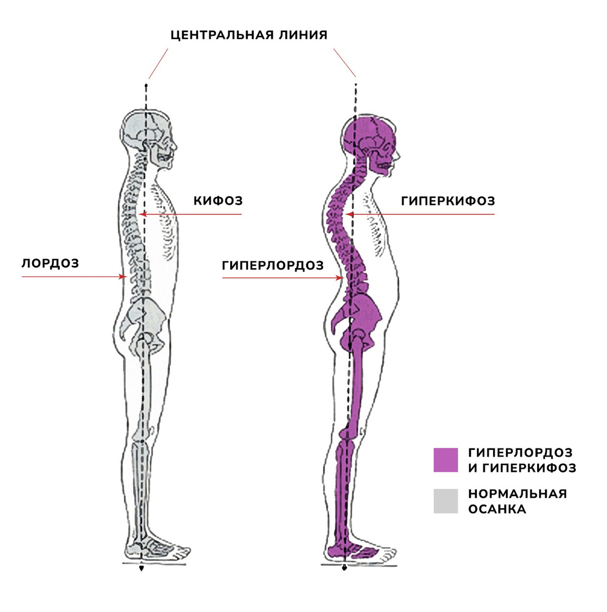 Нормальная осанка и гиперлордоз