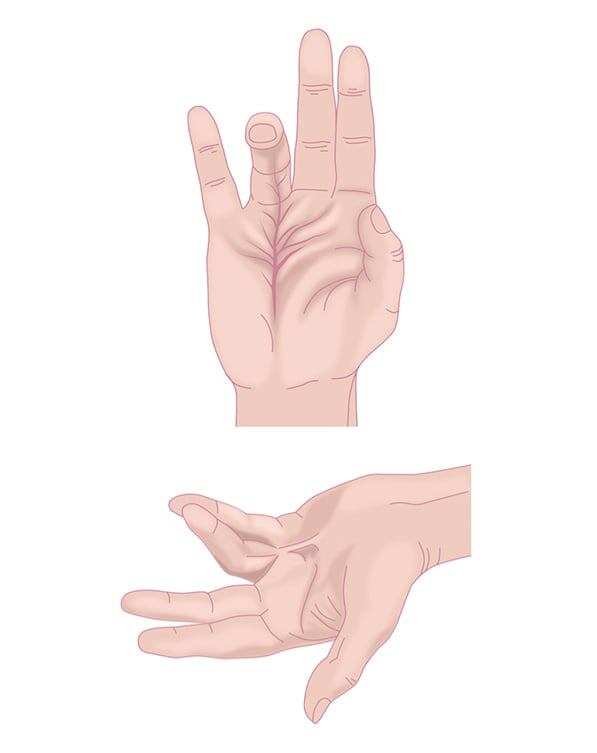 Рис. болезнь Дюпюитрена-утолщение сухожилия безымянного пальца