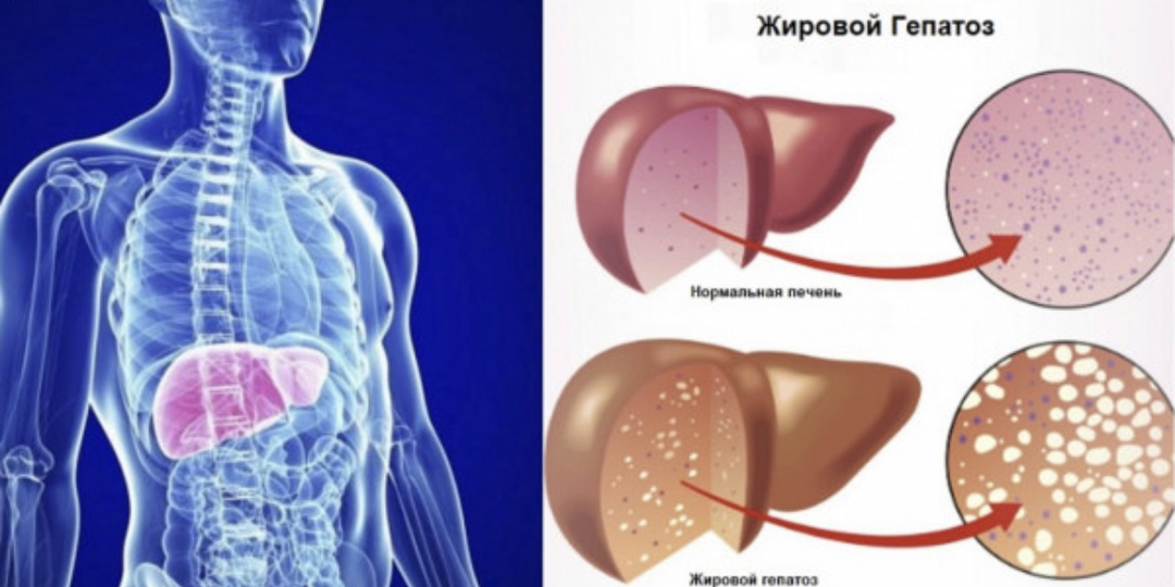 Что такое гепатоз и как его лечить?