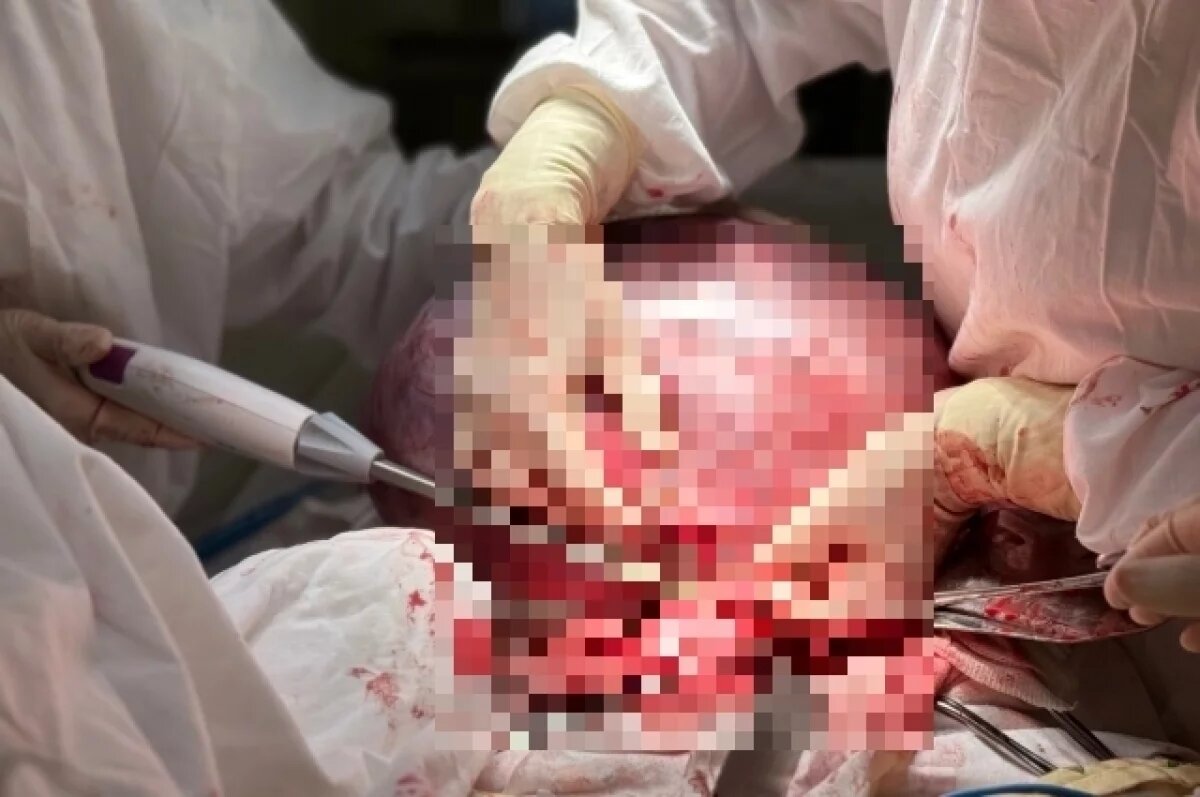    10-килограммовую опухоль яичника удалили у женщины из Бурятии