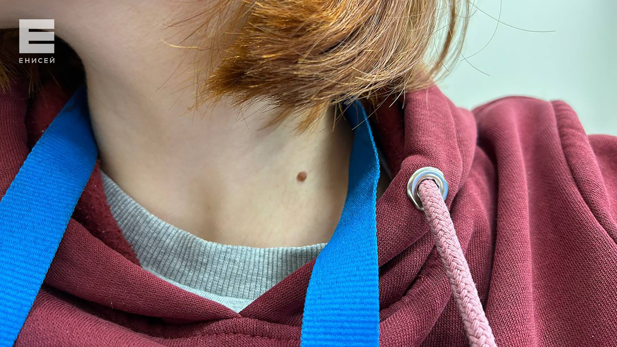     2 апреля красноярцы смогут бесплатно проверить подозрительные родинки