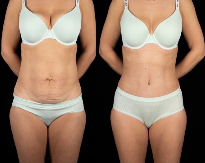 Абдоминопластика с переносом пупка и ушивание диастаза