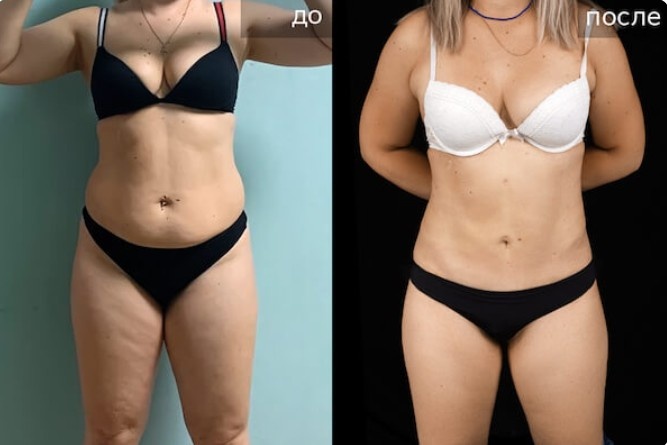 Миниабдоминопластика липосакция