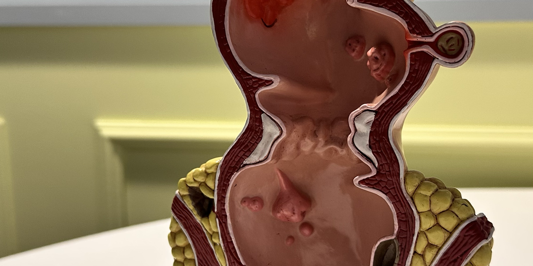 Жизнь без лечения: что будет, если не лечить геморрой?