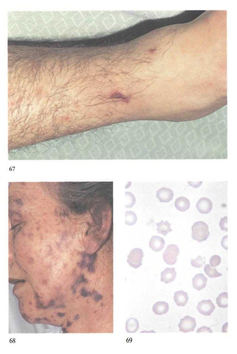 атлас инфекционных болезней: 67 - элемент крупным планом
68 - менингококковый сепсис: крупные элементы звёздчатой формы