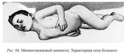 На фото: один из менингеальных симптомов - поза "легавой собаки