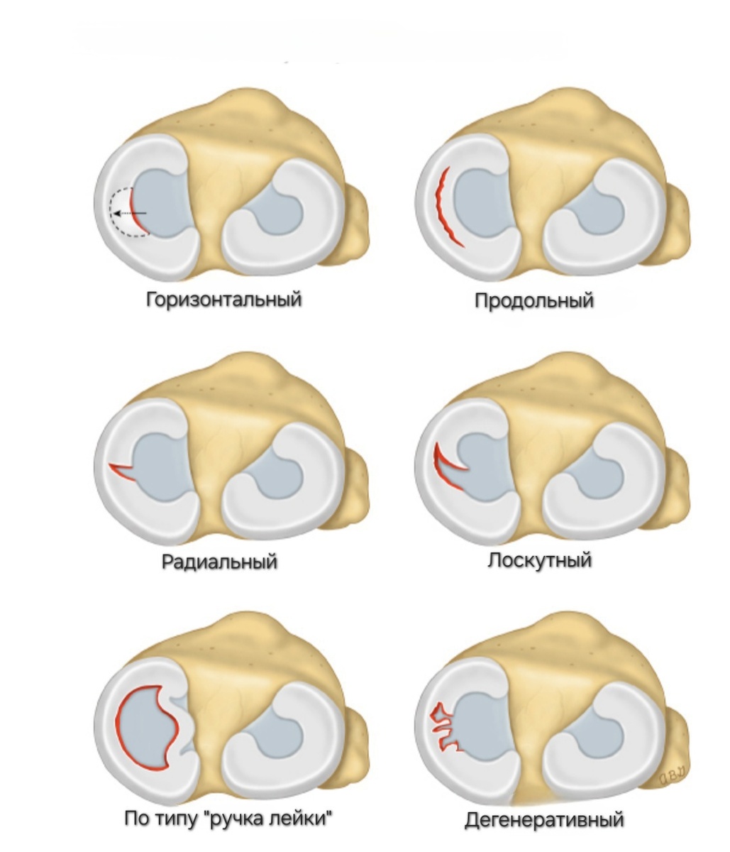 Типы разрывов мениска. Фото взято с сайта UpToDate: Meniscal injury of the knee Authors: Dennis A Cardone, DO, Bret C Jacobs, DO, MA