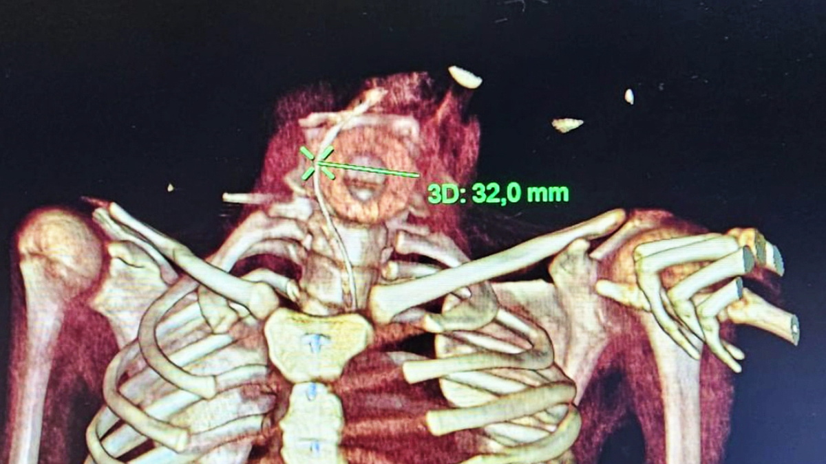    В Нижневартовске ребёнок проглотил деревянное кольцо