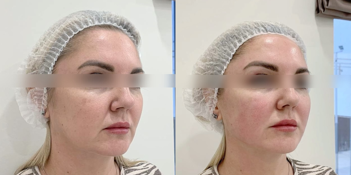 Пример 1. Работа врача-косметолог клиники красоты Бьюти Лаунж Кучминой Антонины Геннадьевны. Ультразвуковой SMAS-лифтинг Ultraformer MPT. 