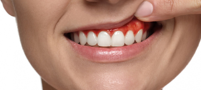 Гингивит. Визуальный пример. Воспаление слизистой обочки дёсен.