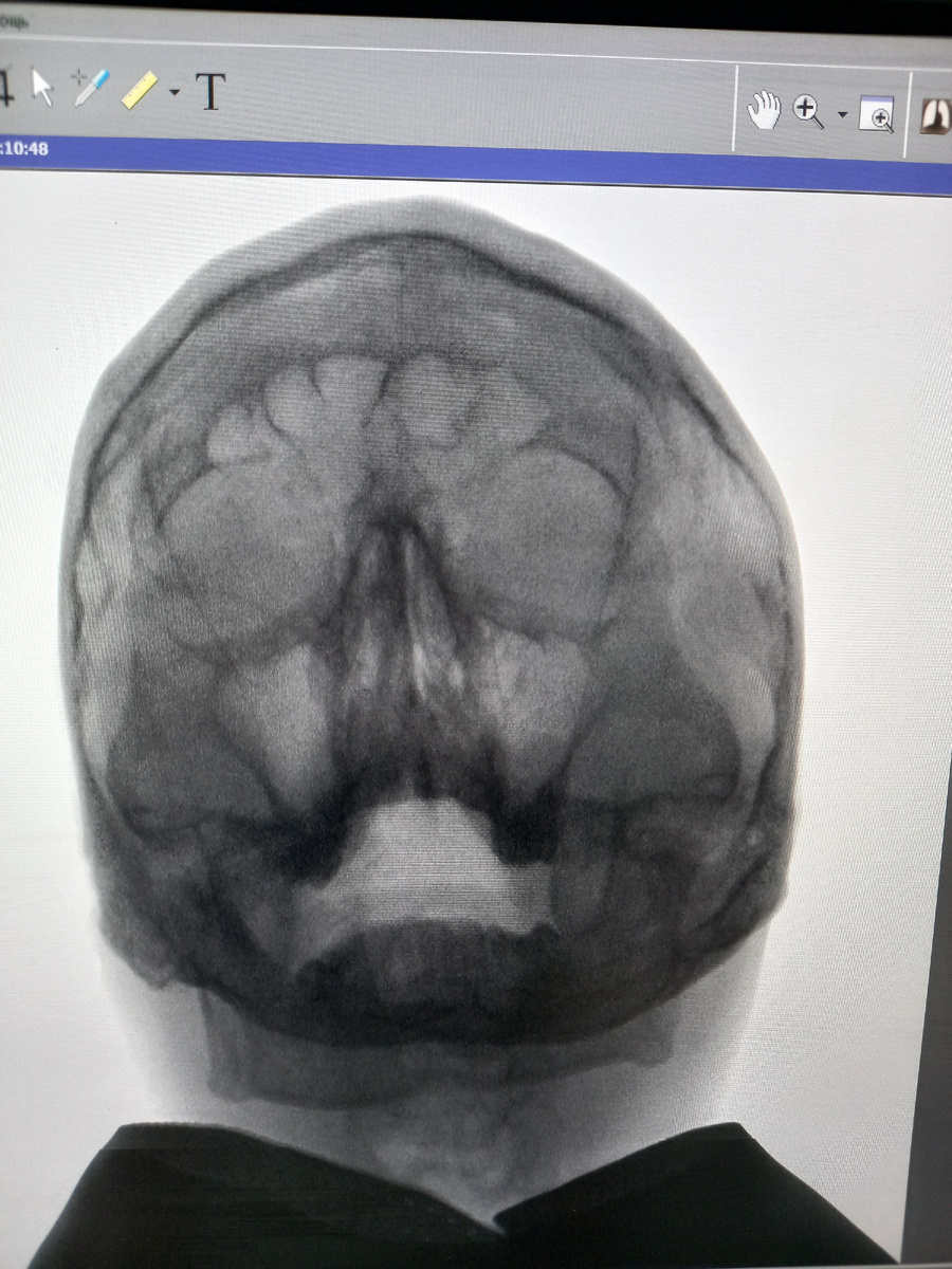 Рентген снимок головы