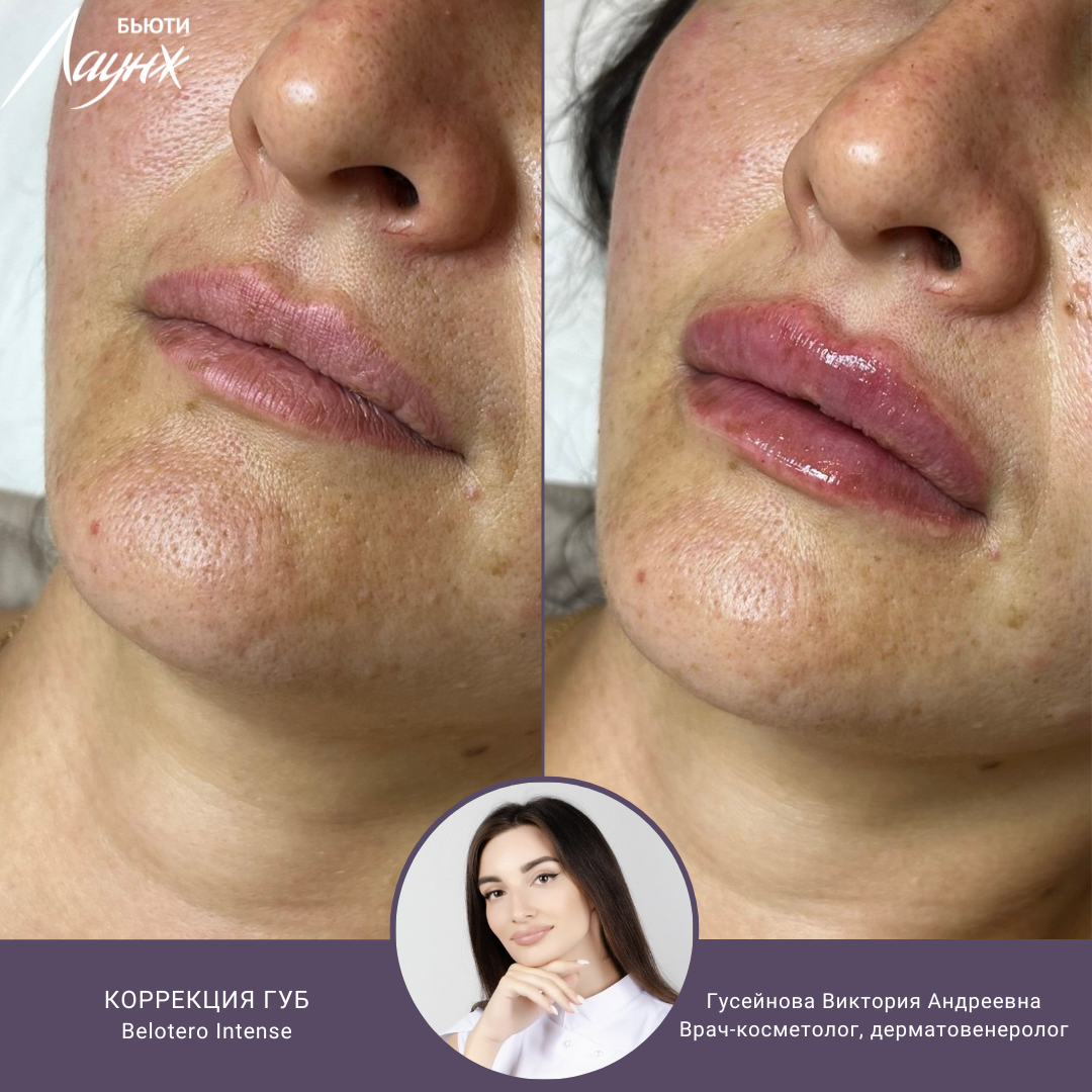 ИМЕЮТСЯ ПРОТИВОПОКАЗАНИЯ, НЕОБХОДИМА КОНСУЛЬТАЦИЯ СПЕЦИАЛИСТА