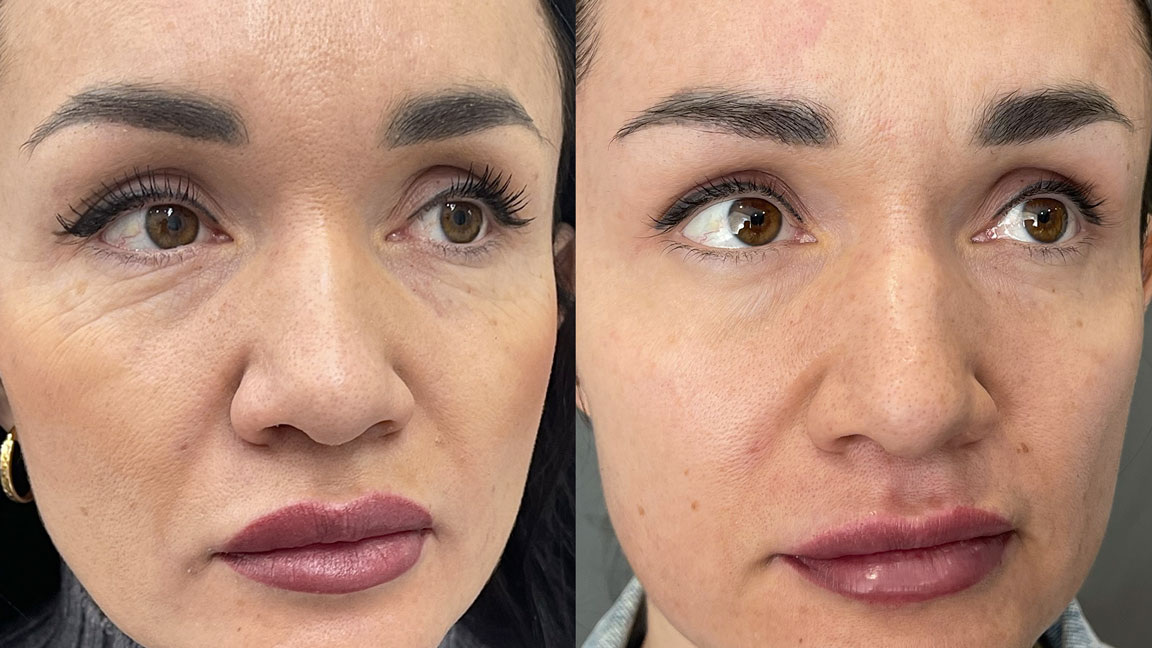 Пациент через 14 дней после лазерной блефаропластики. Врач, Валеева Лилия Рамилевна. Проведена 1 процедура