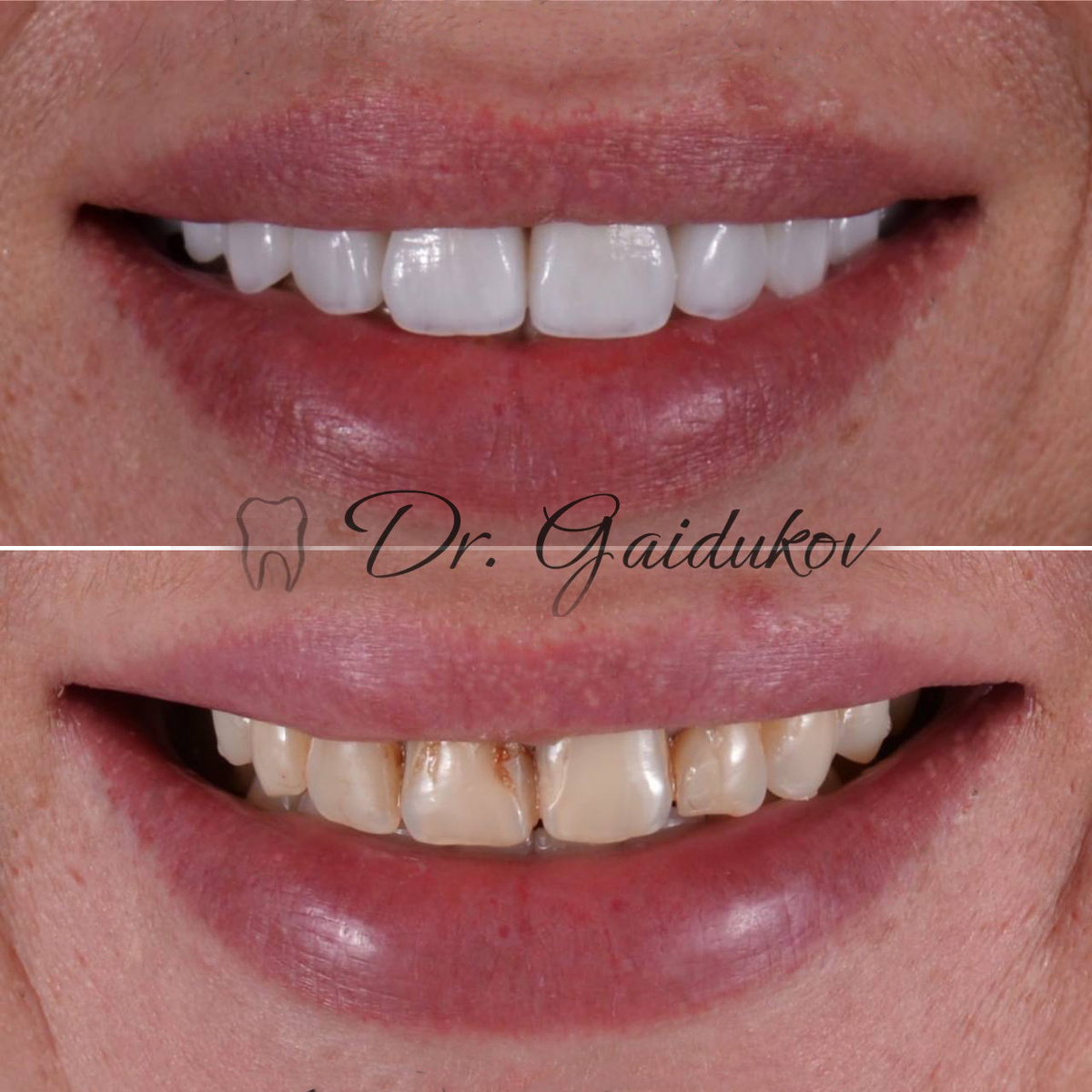 Авторские виниры "Твой Док"