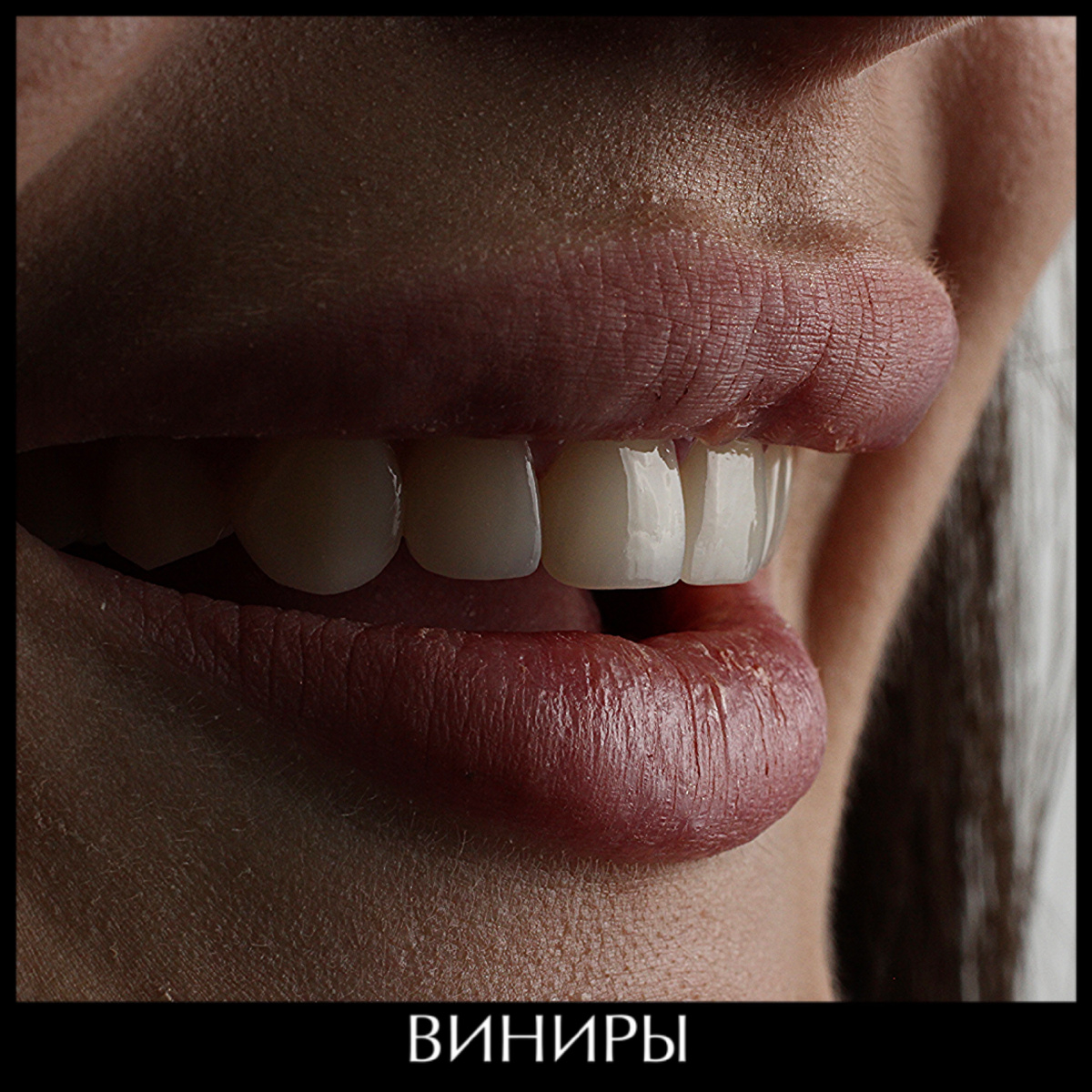 Так выглядят композитные виниры