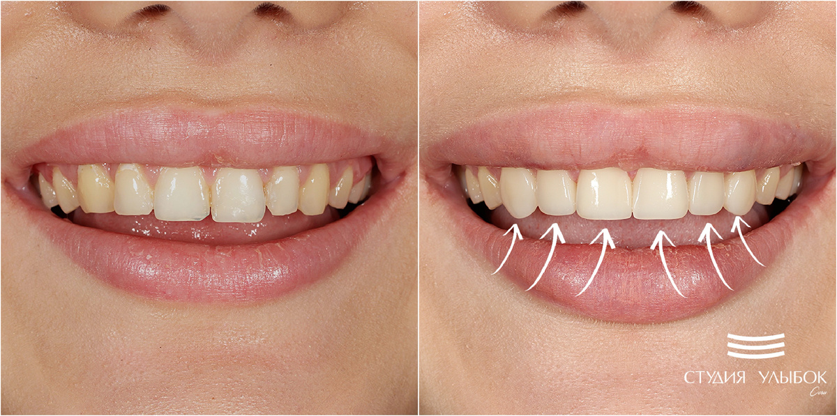 Установка композитных ивниров на фронтальную группу зубов верхней челюсти (зубы: 11,12,13,21,22,23)