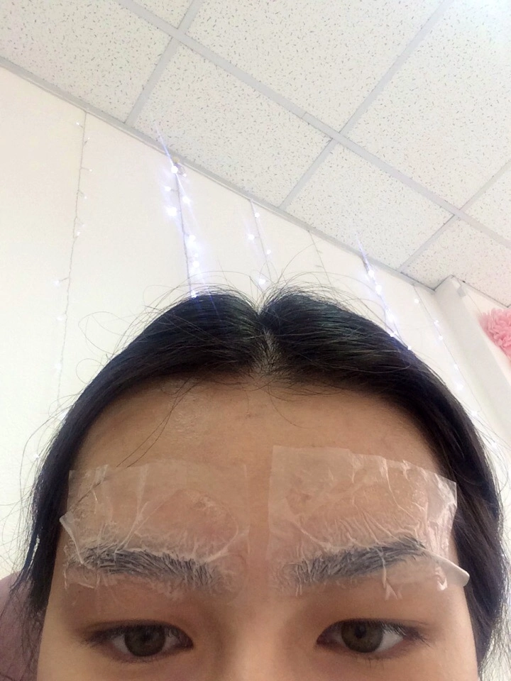 Перед процедурой, нанесли анестезию