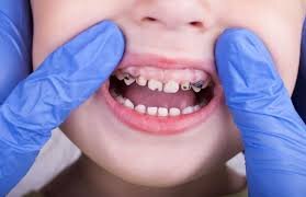 Детский кариес 