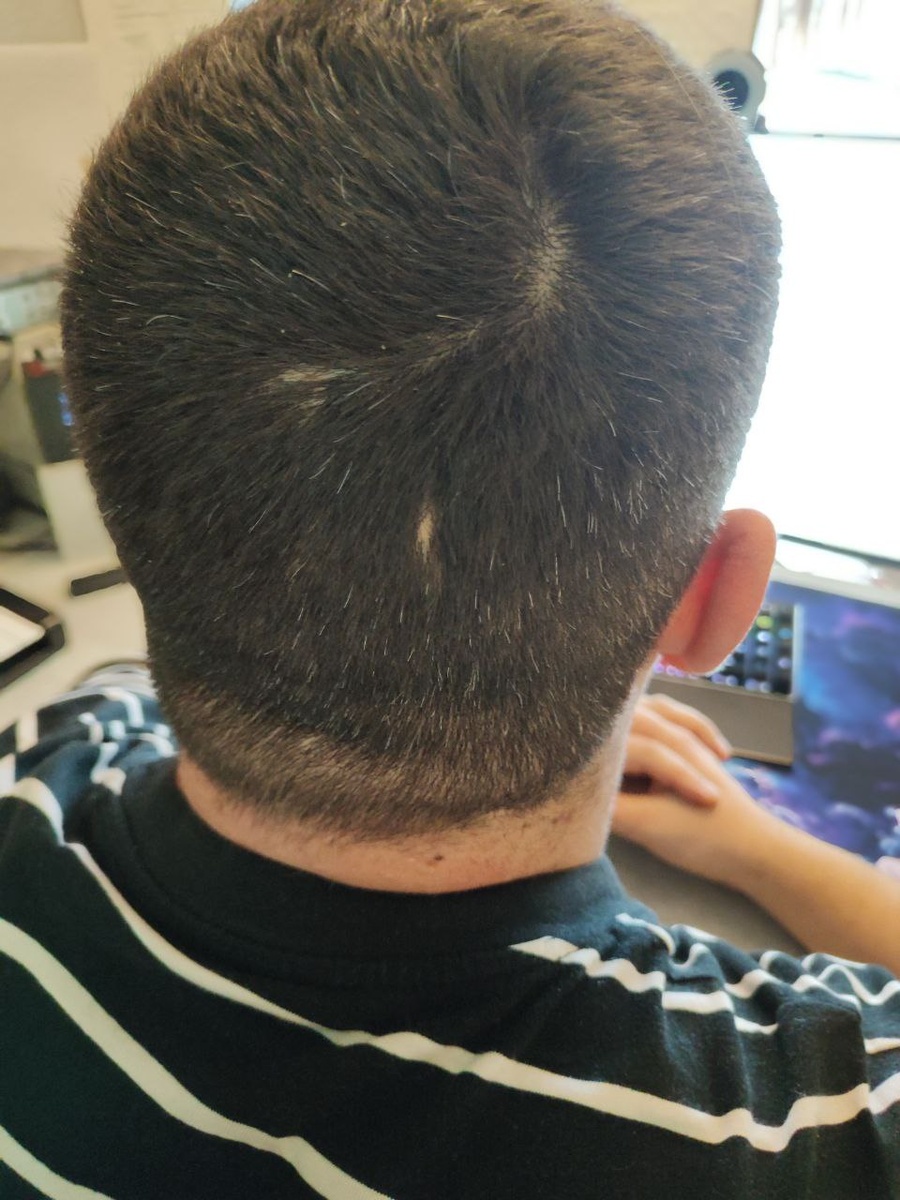 Вот он, тот самый шрам, который ниже от мамкиного сапога. Память на всю жезнь от того дня.